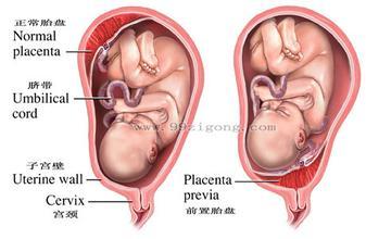 胎盘前置的后果 前置胎盘有哪些后果