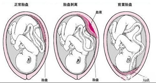 什么是前置胎盘图片 什么是前置胎盘