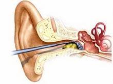 外耳道耵聍 耵聍是耳道的清洁剂
