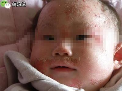 宝宝湿疹一般几天能好 宝宝湿疹会自己好吗