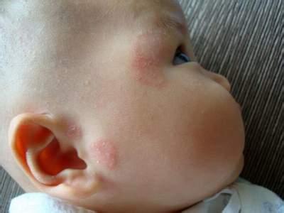 宝宝湿疹常见治疗 关于宝宝湿疹最常见的问题