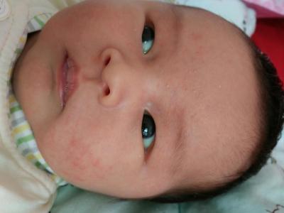 宝宝干性湿疹如何治疗 宝宝湿疹要如何治疗
