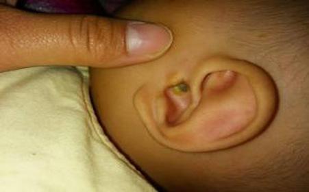 2个月宝宝中耳炎的症状 宝宝中耳炎都有哪些症状