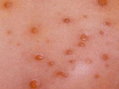 治疗水痘最快偏方秘方 出水痘能吃什么 小儿水痘偏方！