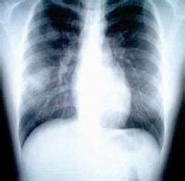 非典型肺炎早期症状 非典型肺炎的症状