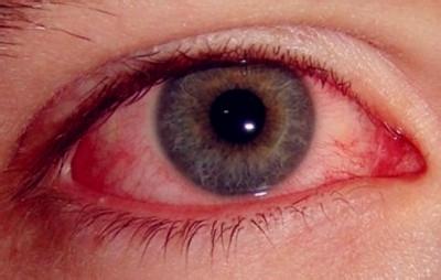 红眼病不能吃哪些东西 红眼病多久能好