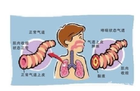哮喘饮食注意什么 儿童哮喘病要注意什么饮食