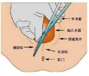 如何避免会阴侧切 会阴侧切无法避免吗?(2)