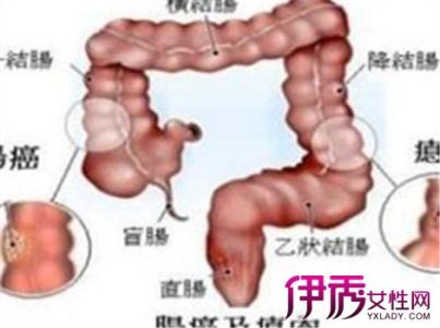 直肠癌晚期症状有哪些 盘点直肠癌晚期症状有哪些