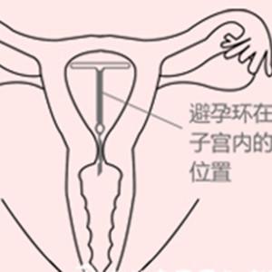 上环对身体有伤害吗 产后避孕上环对身体的伤害有哪些？
