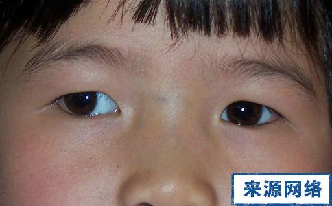 儿童斜视图片 儿童斜视的症状
