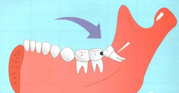 拔智齿的危害 智齿到底该不该拔