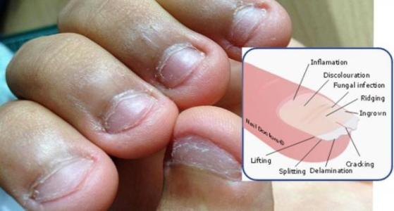 大人咬指甲是什么原因 咬指甲是什么原因