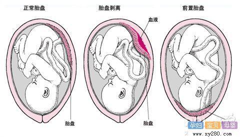 前置胎盘怎样可以上移 前置胎盘怎么办