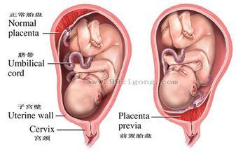 前置胎盘的危害 前置胎盘有哪些危害(2)
