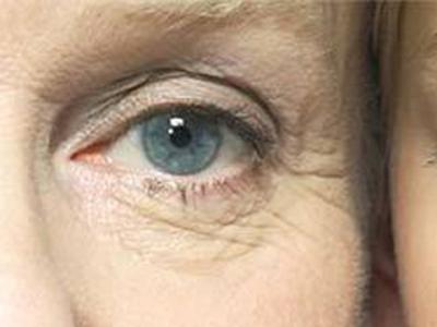 眼睛衰老的表现 怎么预防眼部衰老