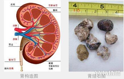 肾结石吃什么食物最好 肾结石不能吃什么