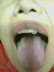 舌头老发黑怎么治 舌头发黑怎么治疗