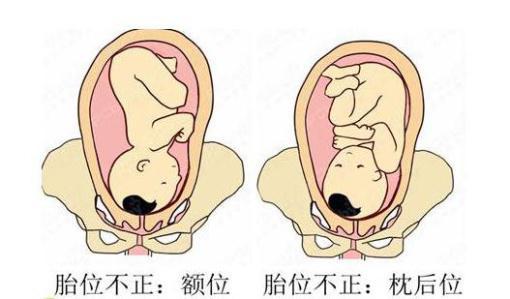 如何判断胎位转正 如何判断胎位