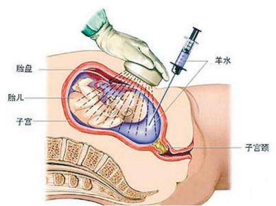 羊水穿刺具体检查什么 羊水穿刺检查是什么