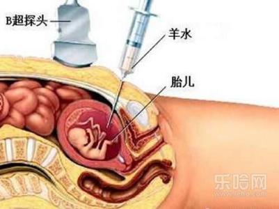 羊水穿刺有哪些风险 做羊水穿刺有风险吗