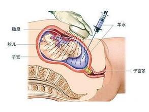 羊水穿刺一定要做吗 哪些人一定要做羊水穿刺