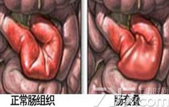 宝宝肠套叠症状 肠套叠怎样快速识别宝宝的症状