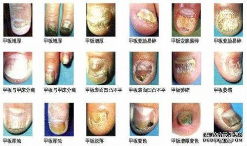 灰指甲的诱发因素 为什么会得灰指甲_得灰指甲的5个因素