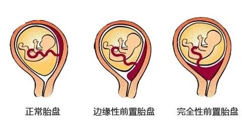 胎盘低置几个月最危险 胎盘低置怎么办