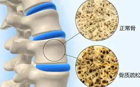 导致骨质疏松的药物 注意几种药物可导致骨质疏松