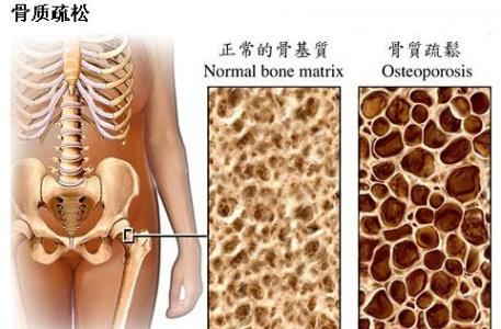 什么是骨质疏松症 什么是骨质疏松