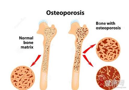 骨质增生骨质疏松 骨质疏松和骨质增生如何区分