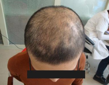 治疗脱发的方法有哪些 脱发有哪些治疗方法