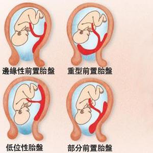 胎盘成熟度和什么有关 胎盘厚度与胎盘成熟度有关吗