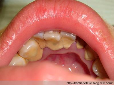 牙垢的危害 4种食物强力去除牙垢_牙垢有什么危害