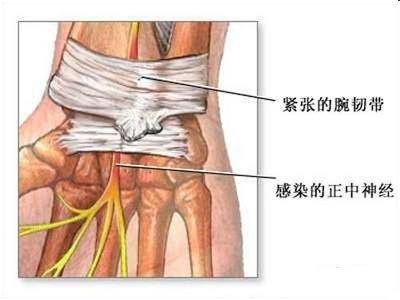 腕管综合征多久能自愈 什么是腕管综合征