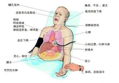 导致心力衰竭的原因 导致心力衰竭的原因有哪些