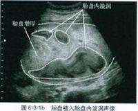 胎盘滞留是指胎儿 胎盘滞留的表现