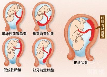 胎盘滞留不处理会怎样 胎盘滞留怎么办