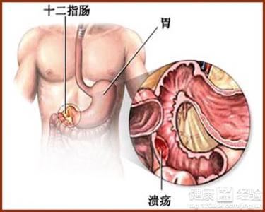 胃溃疡是怎么引起的 胃溃疡饮食要注意什么