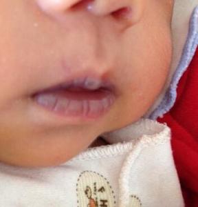 婴儿嘴唇发紫的图片 婴儿嘴唇发紫是什么原因