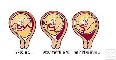 前置胎盘的护理措施 前置胎盘的护理_前置胎盘有哪些护理措施(2)