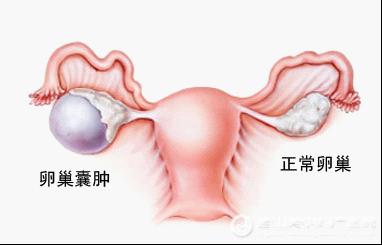 卵巢囊肿的病因 卵巢囊肿的病因有哪些