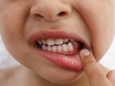 儿童如何防止蛀牙 儿童蛀牙怎么办？防止蛀牙的方法