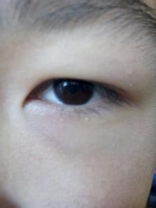 眼睛黑眼圈的原因 眼睛有黑眼圈怎么办？黑眼圈的原因(2)