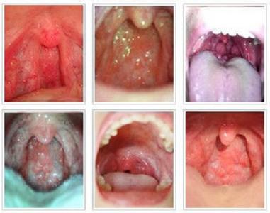 咽喉炎最佳治疗方法 咽炎是怎么引起的？咽炎的治疗方法(2)