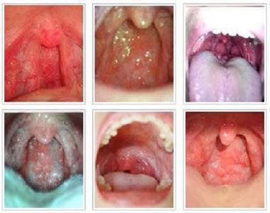 咽喉炎最佳治疗方法 咽炎是怎么引起的？咽炎的治疗方法(3)