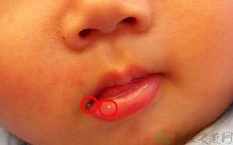 烂嘴角怎么治疗 孩子“烂嘴角”怎么治疗