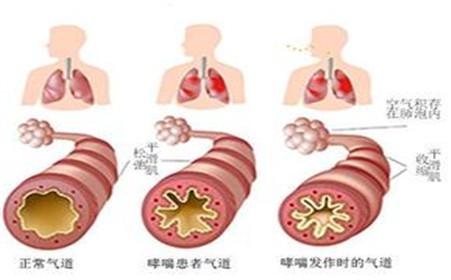 哮喘的症状有哪些 哮喘有哪些症状 哮喘的常见症状