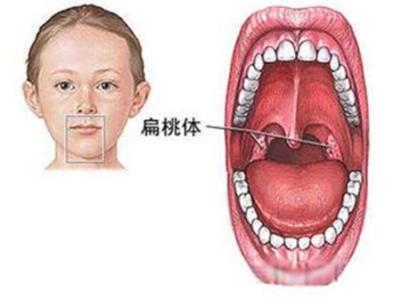 如何消除扁桃体肿大 小儿扁桃体肿大的原因